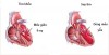 Suy tim cấp và sốc tim