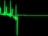 Điện tâm đồ bình thường và một số bệnh lý