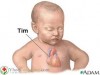 Đại cương về tim bẩm sinh