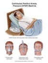 CPAP ( continuous positive airway pressure )