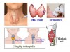 BỆNH TUYẾN GIÁP