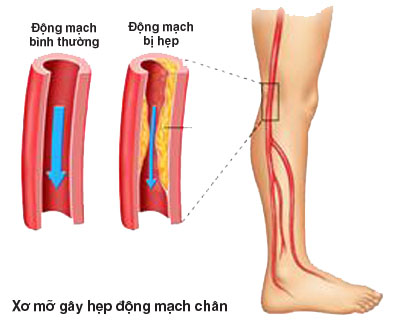 Benh dong mach ngoai bien cua chi duoi c3da0